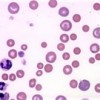Vet News – Small Animal News Immune Mediated Haemolytic Anaemia, blood smear