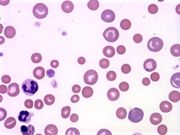 Immune Mediated Haemolytic Anaemia, blood smear