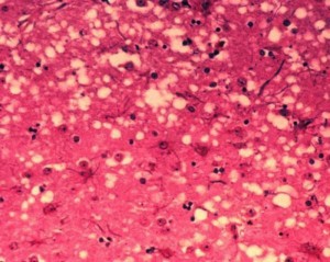 micrograph of prion affected neural tissue